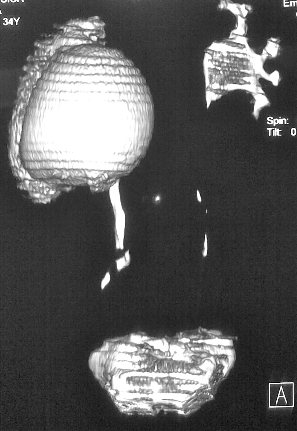 Urotomograf&iacute;a con estenosis UP der.