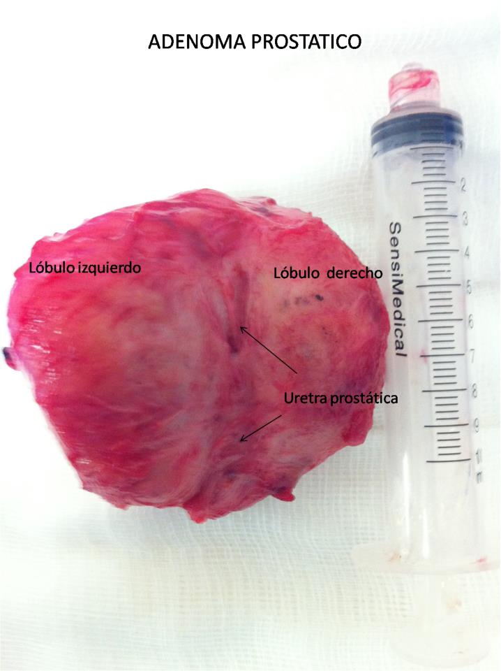 Adenoma de 100gr