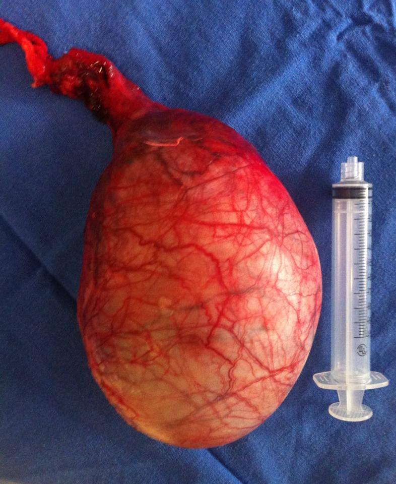 PIEZA QUIRURGICA (TEST&Iacute;CULO CON TUMOR)