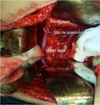 Plast&iacute;a desmembrada