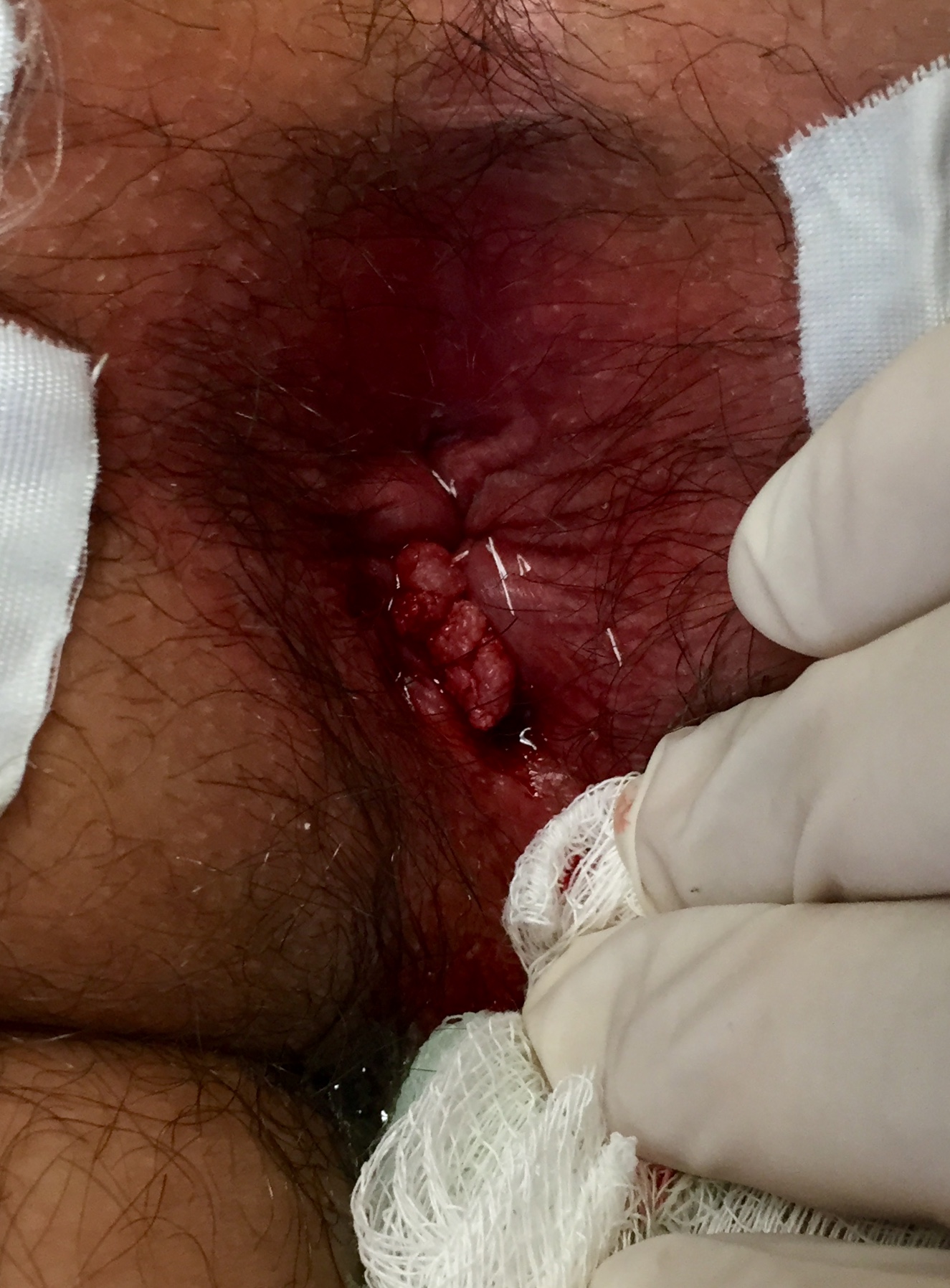 Lesiones verrugosas mucosa anorectal