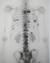 Gamagrama &oacute;seo con m&uacute;ltiples met&aacute;stasis a arcos costales y columna