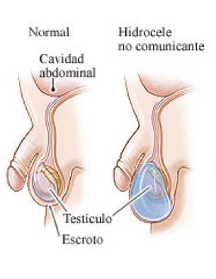 HIDROCELE NO COMUNICANTE HIDROCELE NO COMUNICANTE