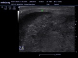 Test&iacute;culo con c&aacute;ncer, de ecogenicidad heterog&eacute;nea por ultrasonido
