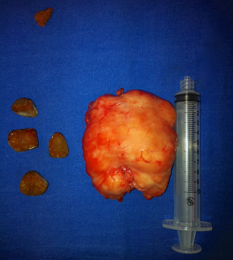 Arriba lito ureteral, abajo litos vesicales, y adenoma prostático de 150gr Arriba lito ureteral, abajo litos vesicales, y adenoma prostático de 150gr