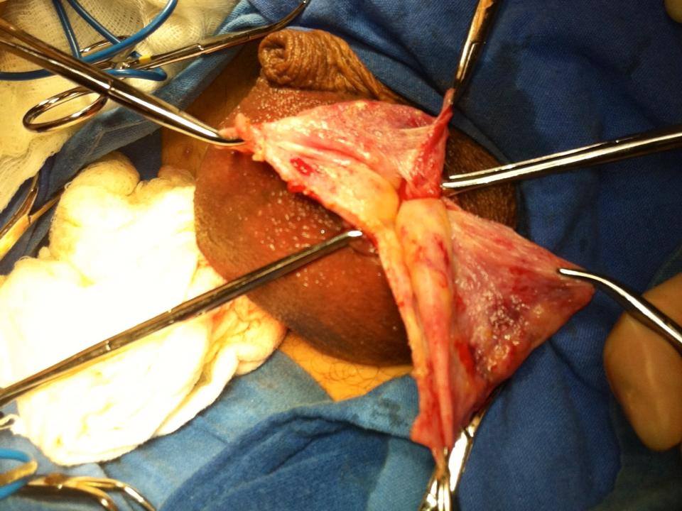 Túnica vaginal excedente a resecar Túnica vaginal excedente a resecar