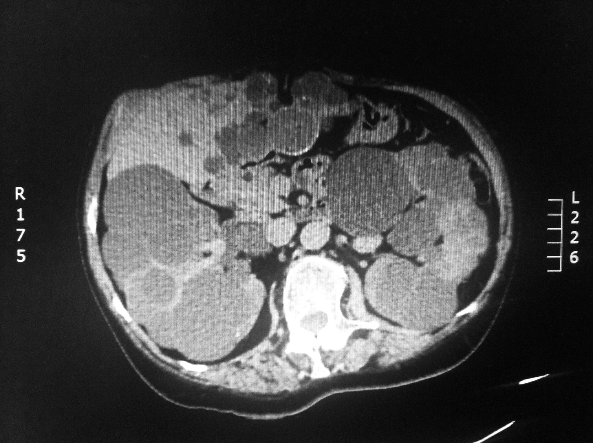 Quistes renales y hep&aacute;ticos m&uacute;ltiples