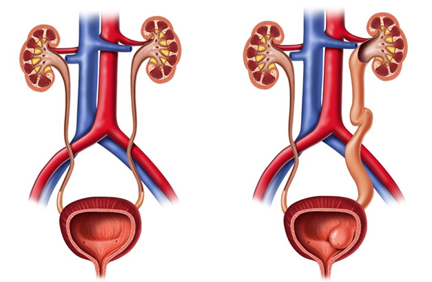 Sistema urinario normal a la izquierda y sistema urinario con ureterocele  y dilataci&oacute;n ur&eacute;ter y ri&ntilde;&oacute;n en esquema del lado derecho
