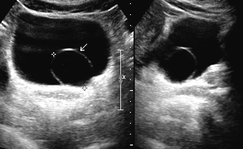 Dilataci&oacute;n qu&iacute;stica del ureter